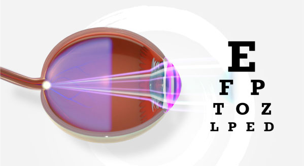 Comparison of an eye without myopia to an eye with myopia